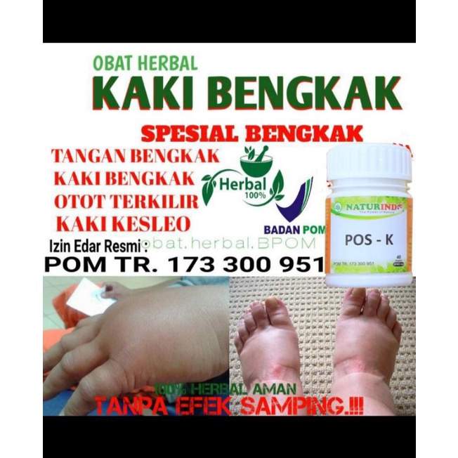 Jual Obat Kaki Bengkak Tangan Bengkak Abuh Memar Otot Keseleo Syaraf Terkilir Bengkak Ginjal