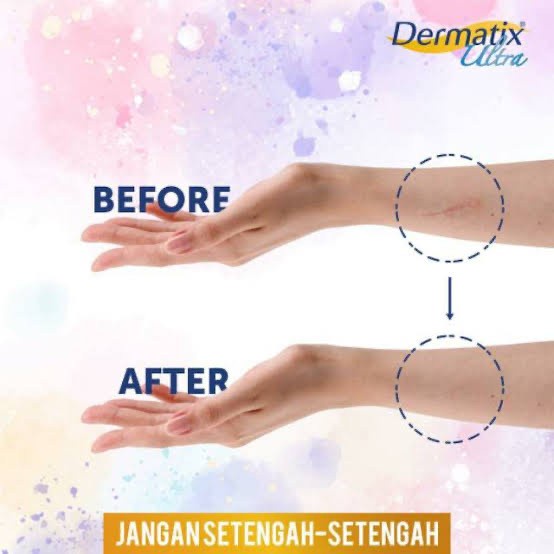 Dermatix Ultra Obat Penghilang Bekas Luka Salep Bekas Luka 15gr