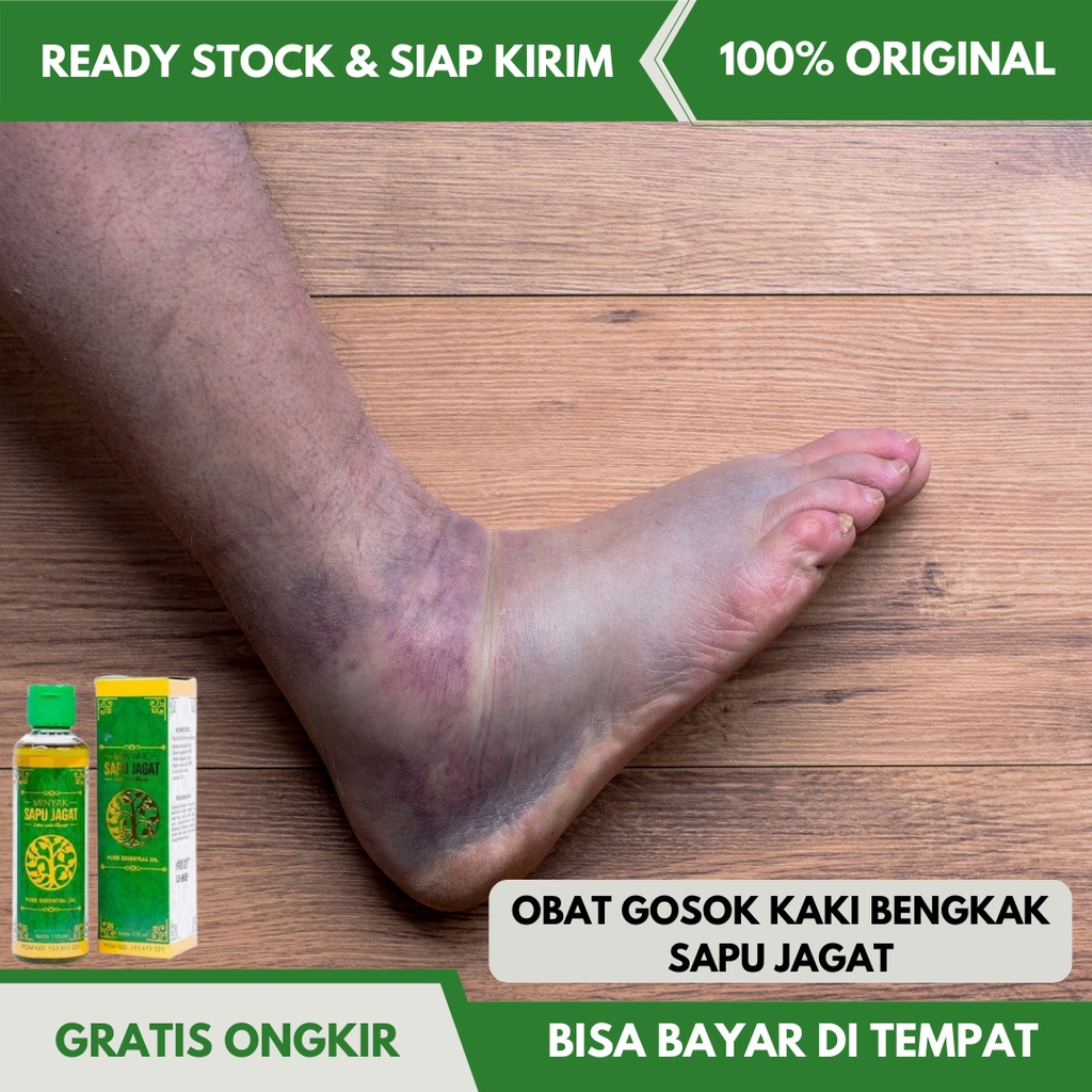 Obat Gosok Untuk Kaki Bengkak,  Obat Kaki Bengkak Asam urat, Obat Kaki Bengkak dan Nyeri, Obat Menge