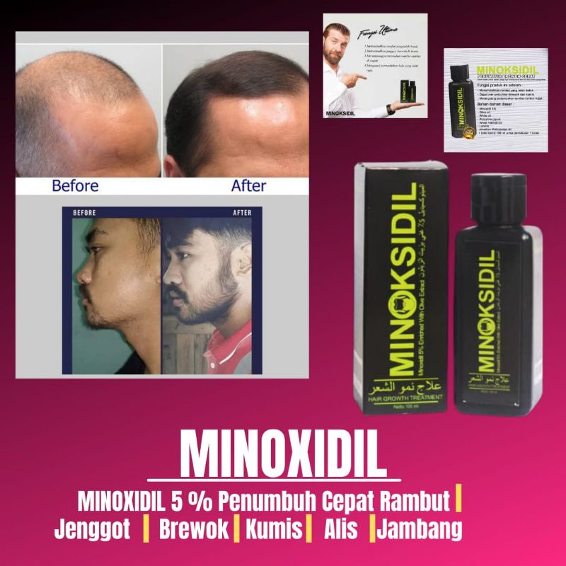 Minoksidil Obat Oles Penumbuh Rambut Penumbuh Brewok dan Jenggot Paling Cepat dan Ampuh