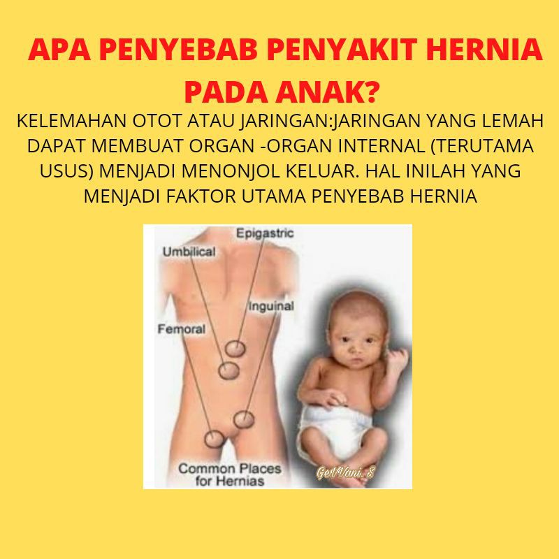 Celana Hernia Celana Hernia Anak Celana Terapi Hernia Aman Nyaman Murah Berkualitas