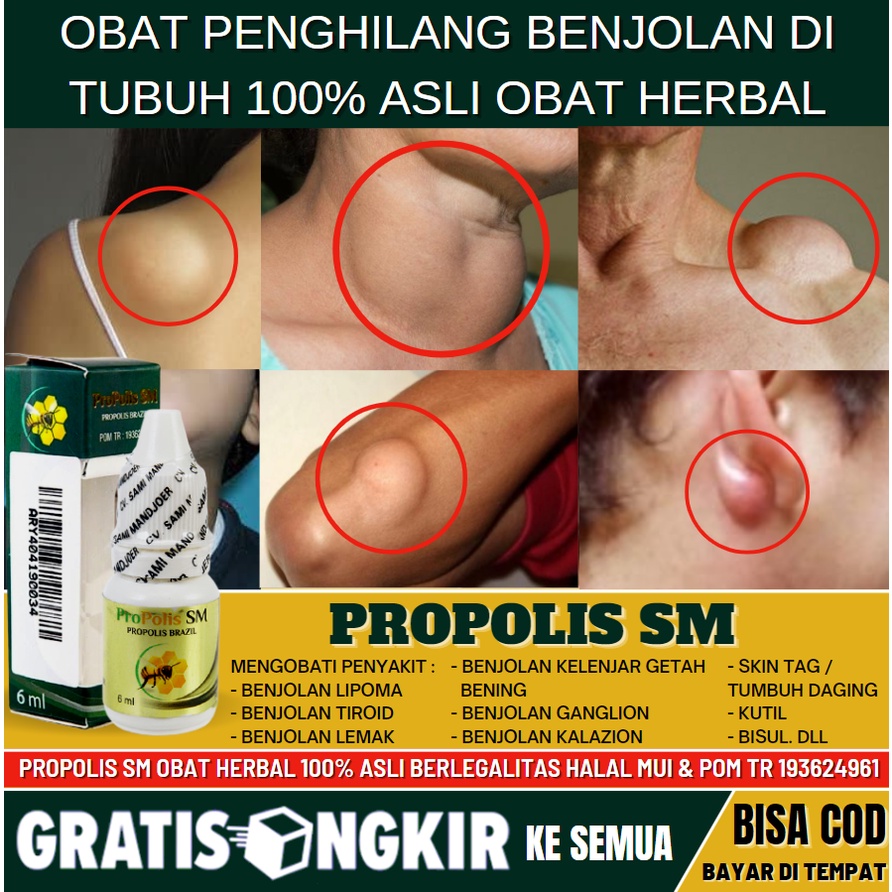 Obat Benjolan di Selangkangan 100% Asli Alami, Benjolan di Daerah Kelamin Pria & Wanita, Obat Oles P