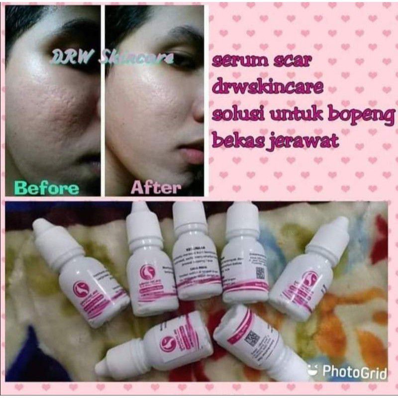 Serum Scar Drw Skincare Original Bpom Untuk Menghilangkan Bekas Jerawat Bopeng Shopee Indonesia