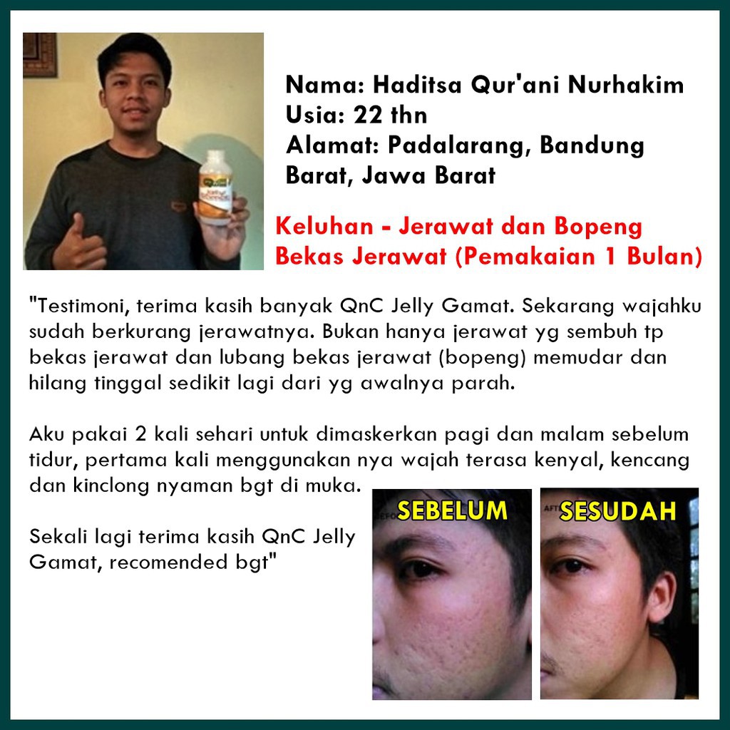 Obat Oles Penghilang Jerawat Masker Bopeng Flek Hitam Qnc Jelly Gamat Indonesia