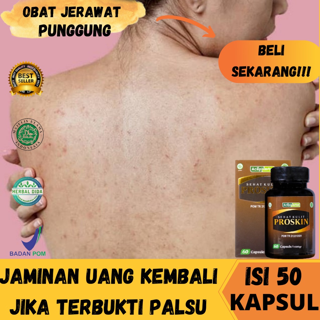 Obat Jerawat Punggung, Obat Jerawat di Punggung Dan Bekasnya, Obat Penghilang Jerawat Punggung, Obat