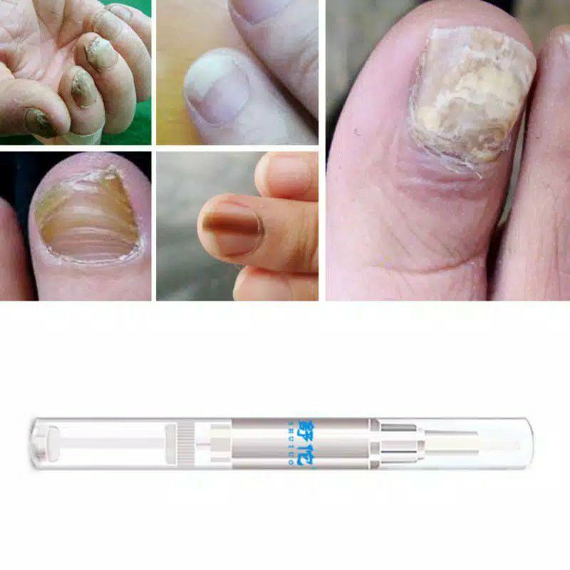 Cairan Obat Infeksi Anti Jamur Untuk Perawatan Kuku Nail Care Solution