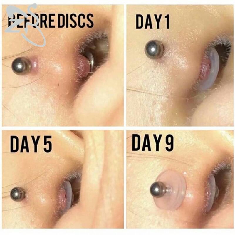 No pull piercing aftercare obat tindik keloid