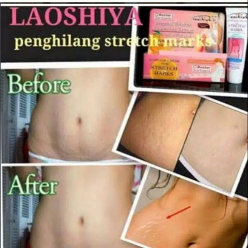 TERAMPUH Penghilang strechmark salep penghilang bekas luka penghilang keloid penghilang selulit