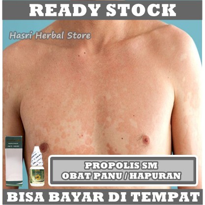 Obat Panu Di Wajah, Obat Panu di Leher, Obat Panu Di Punggung, Obat Penghilang Panu di Kulit, Obat Panu Di Tangan &amp; Kaki, Obat Balas Bogo, Obat Hapuran, Obat Kulit Hapur, Obat Kulit Gatal2, Obat Eksim Kering &amp; Basah Menahun