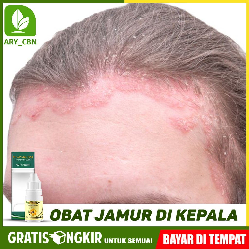 

Obat Jamur Di Kepala, Psoriasis Ketombe Gatal Di Kepala Herbal PROPOLIS SM Di Cirebon Bisa COD