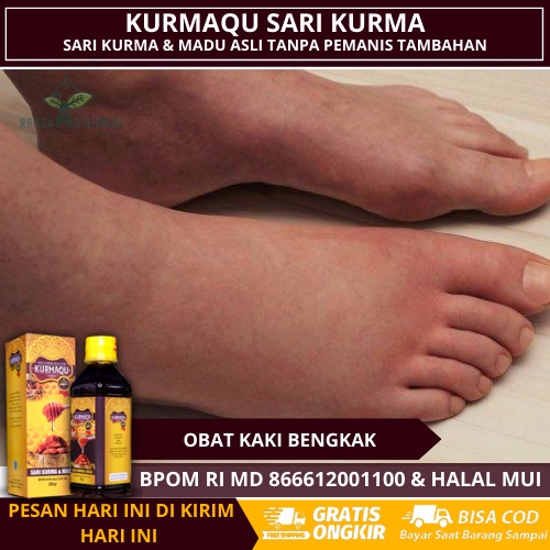 Obat Untuk Kaki Bengkak, Obat Kaki Bengkak Diabetes, Obat Kaki Bengkak asam urat, Obat Kaki Bengkak 