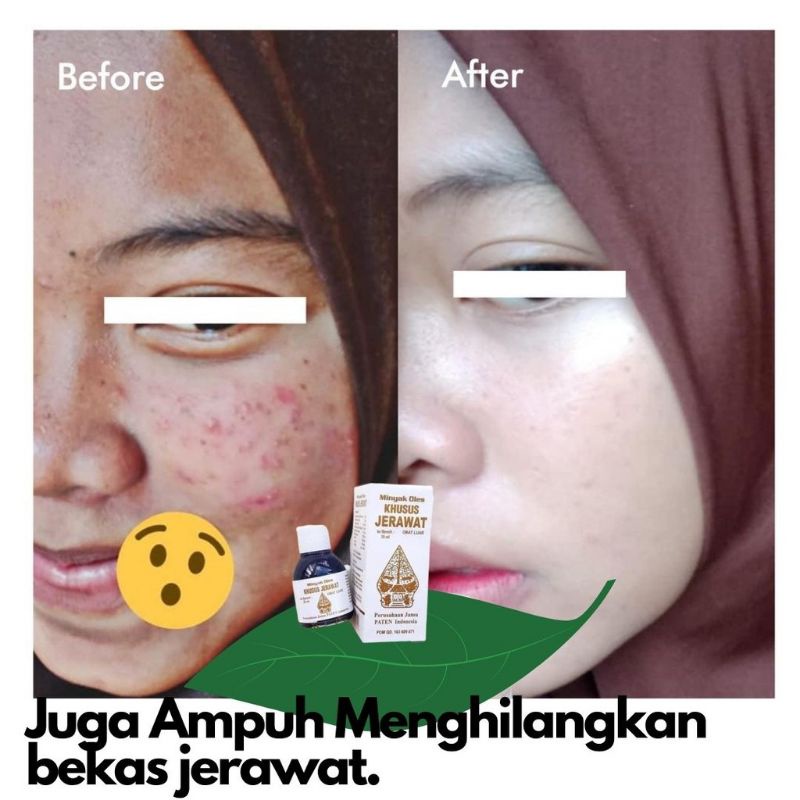 Jerawat Dan Bekas Jerawat - Batu - Punggung - Pria Wayang Natural