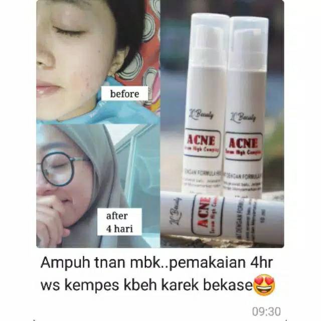 Serum Acne Kf Skin Bpom Shopee Indonesia