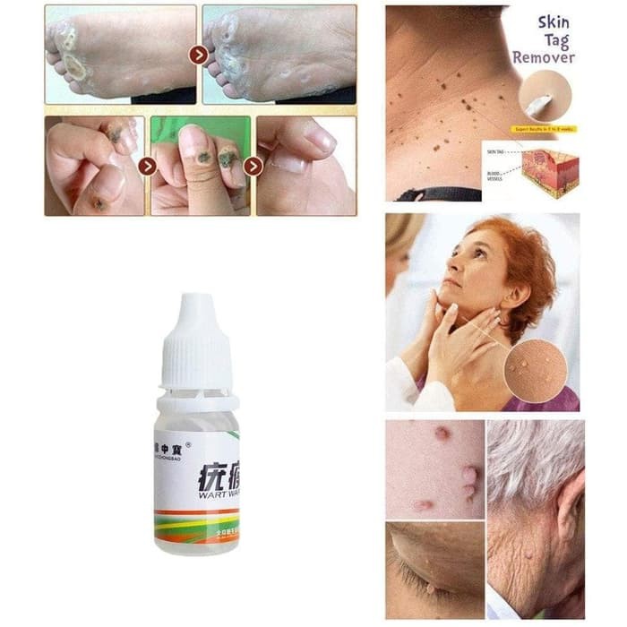 Obat Penghilang Kutil Tahi Lalat Ampuh  / Skin Tag Remover Original Recomendid