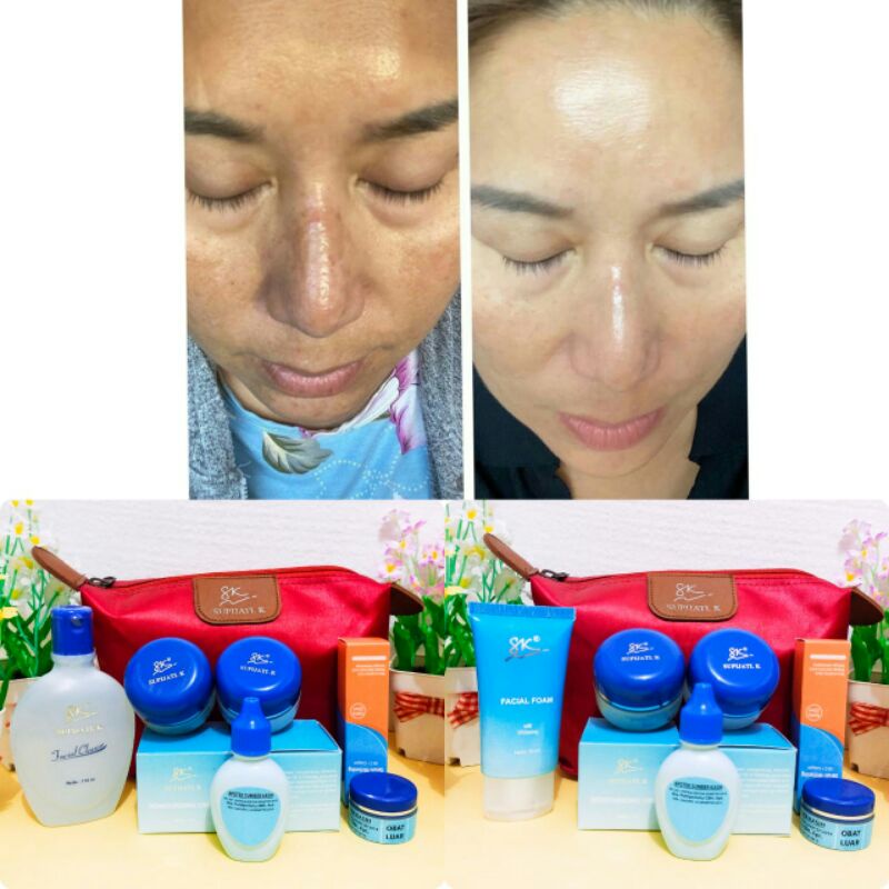 Paket flek hitam whitening  SK supijati K