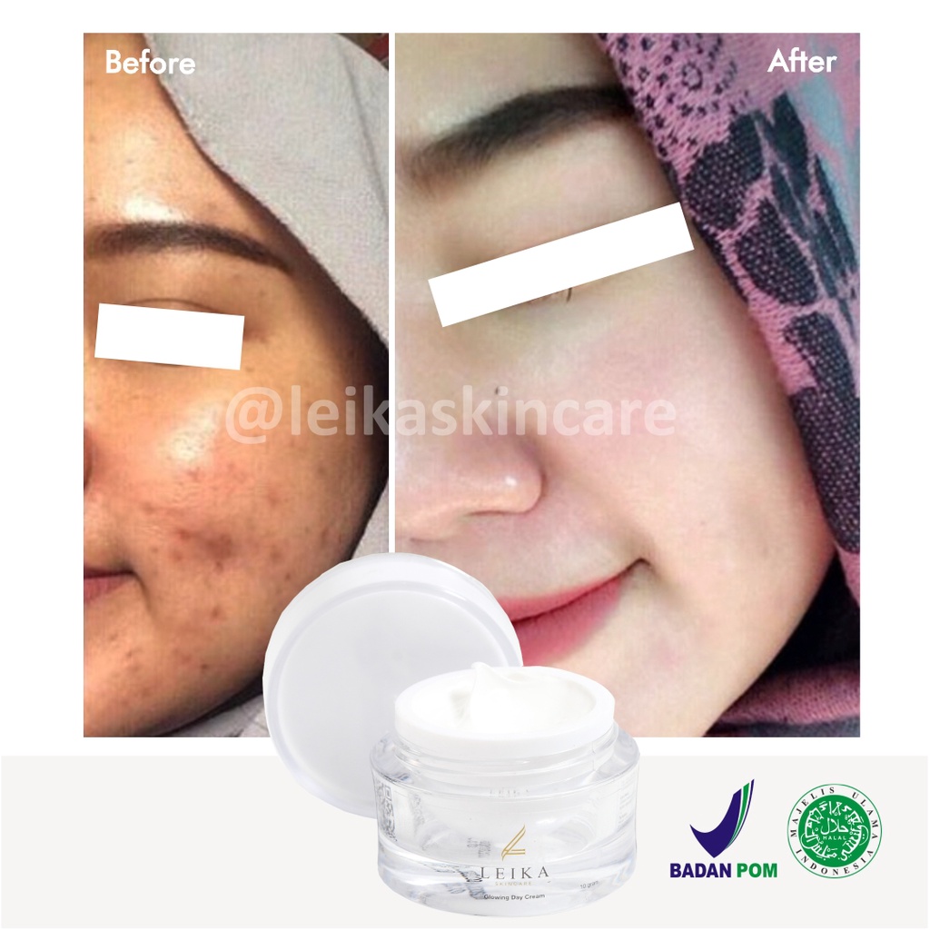 Krim Wajah Penghilang Bekas Luka Jerawat Asli 100% Ampuh! Penghilang Bekas Jerawat Bopeng Cepat BPOM Halal MUI Penghilang Bekas Jerawat Menghitam Glowing Day Cream Leika Skincare 10gr Original