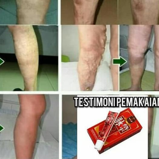 Ready / Obat varises / cream kaki varises / varicos veins ampuh / varises Real-Pict,..