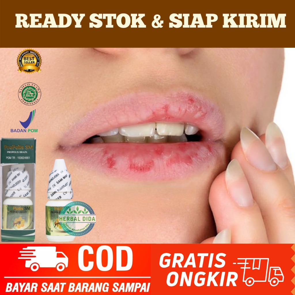 Obat herbal bibir pecah-pecah anak & dewasa, Obat Bibir Pecah-Pecah, Bibir Pecah pecah & Kering, Oba