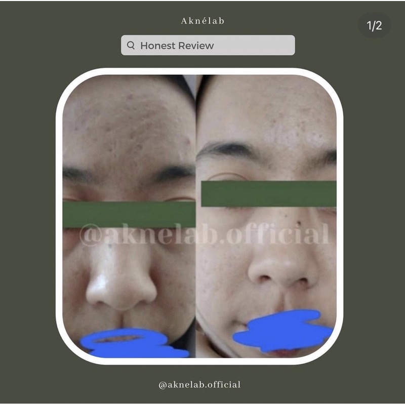 1 paket rangkaian anti scars (menghilangkan bopeng)