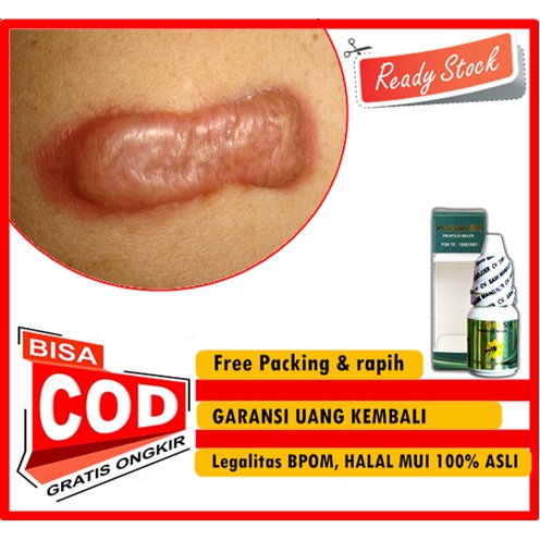 Pengobatan untuk Mengatasi Keloid di Tubuh, Obat Menghilangkan Keloid, Menghilangkan Keloid dengan C
