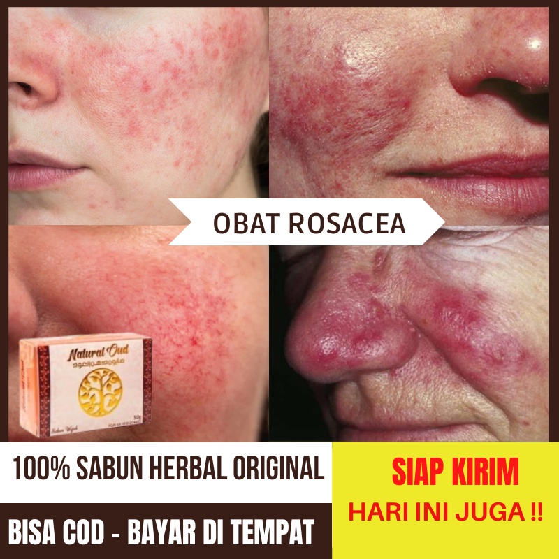 Jual Obat Rosacea, Kulit Wajah Kemerahan, Jerawat Rosasea, Rosacea di