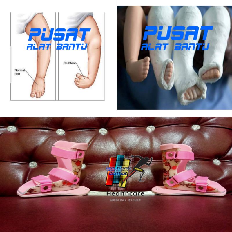 Sepatu koreksi anak CTEV