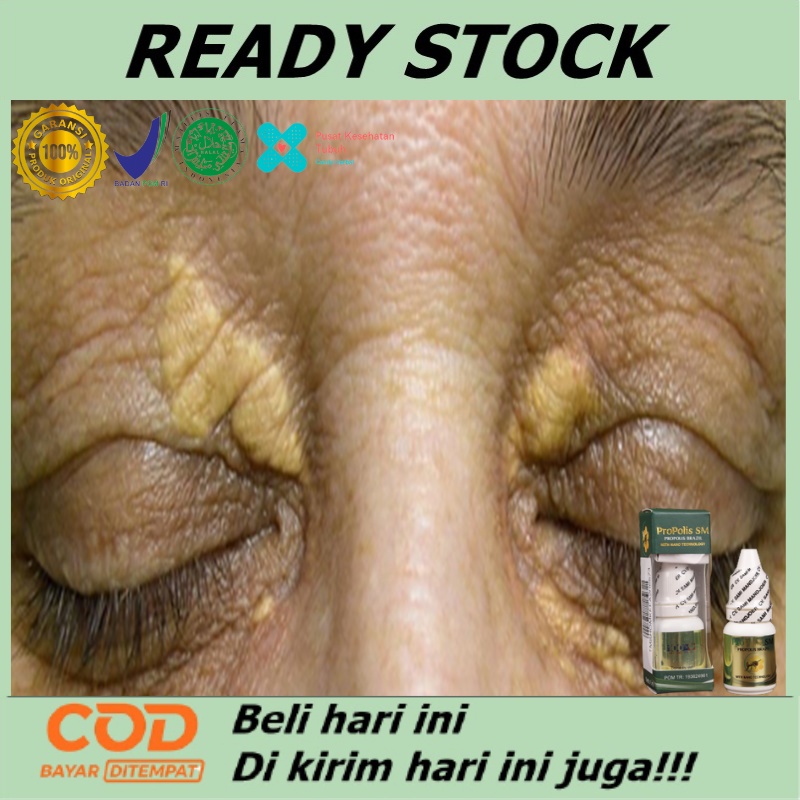 Xanthelasma Alami, Obat Penghilang Xanthelasma, Obat Oles Penghilang Xanthelasma, Obat Xanthelasma G