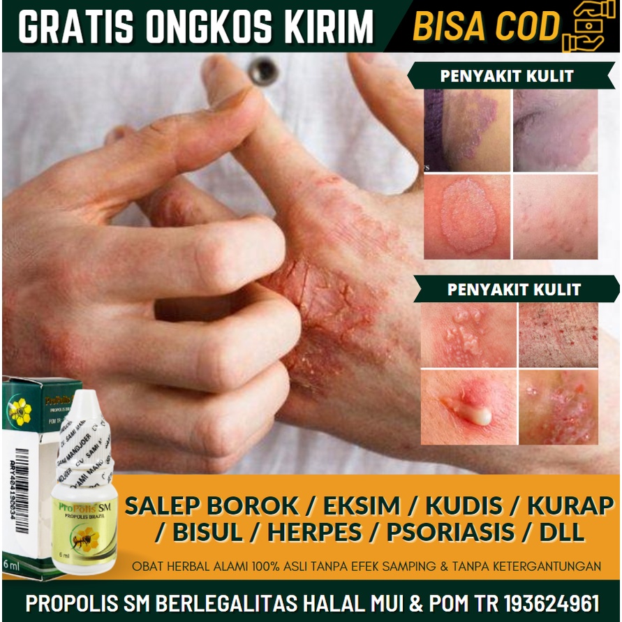 Obat Borok, Salep Borok di Badan 100% ASLI Alami, Obat Oles Borok Tanpa Efek Samping, Obat Borok Unt