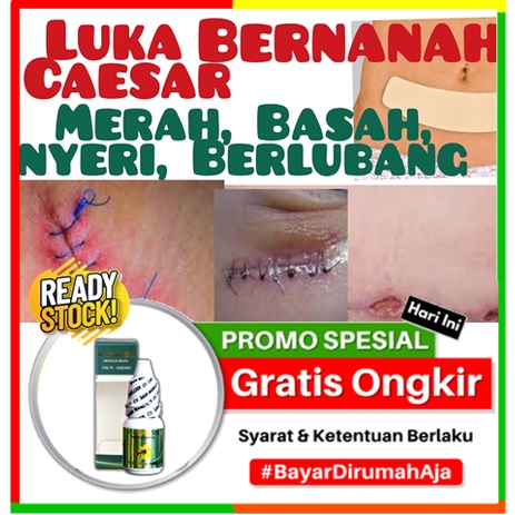 Obat Untuk Mengeringkan Luka Pasca Operasi Caesar - Obat Pengering Luka Pasca Operasi Caesar, Salep 