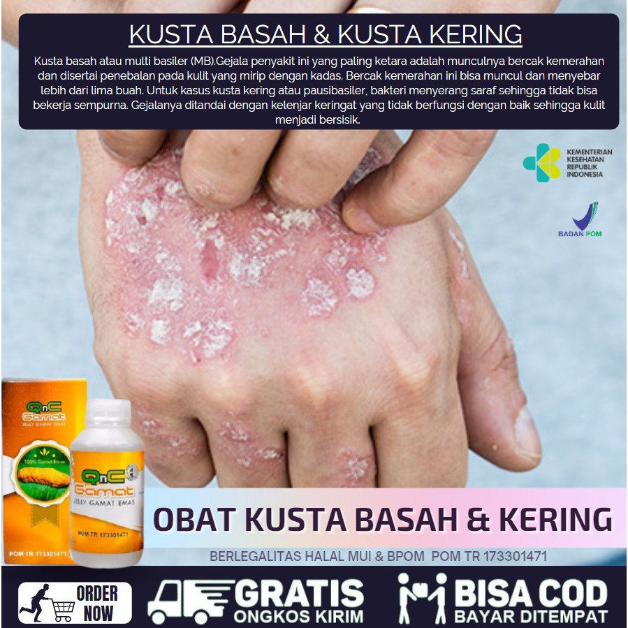 Obat Penyakit Kusta Basah & Kusta Kering, Obat Lepra Atau Kusta Untuk Anak & Dewasa QnC Jelly Gamat