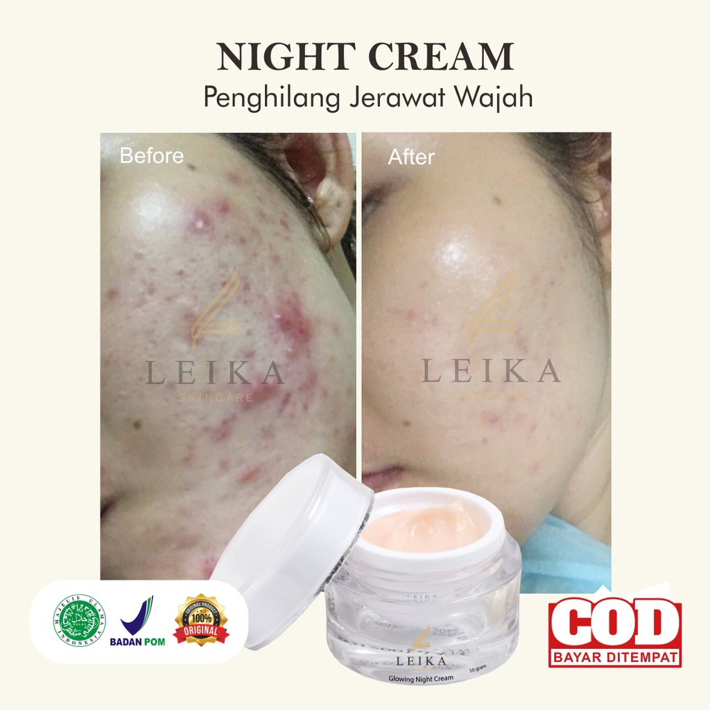 Krim Penghilang Jerawat Krim Jerawat Penghilang Jerawat Batu Anti Acne Night Cream Perawatan Wajah J