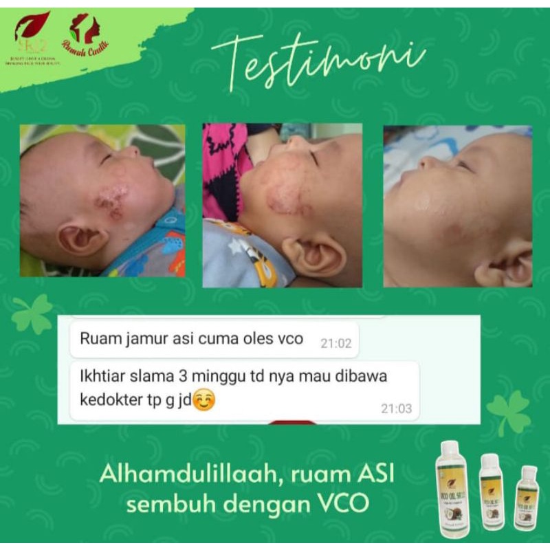 "Terlaris" Vco SR12 / Minyak kelapa untuk ruam pada bayi / Gatal-gatal pada bayi / Biang Keringat / 
