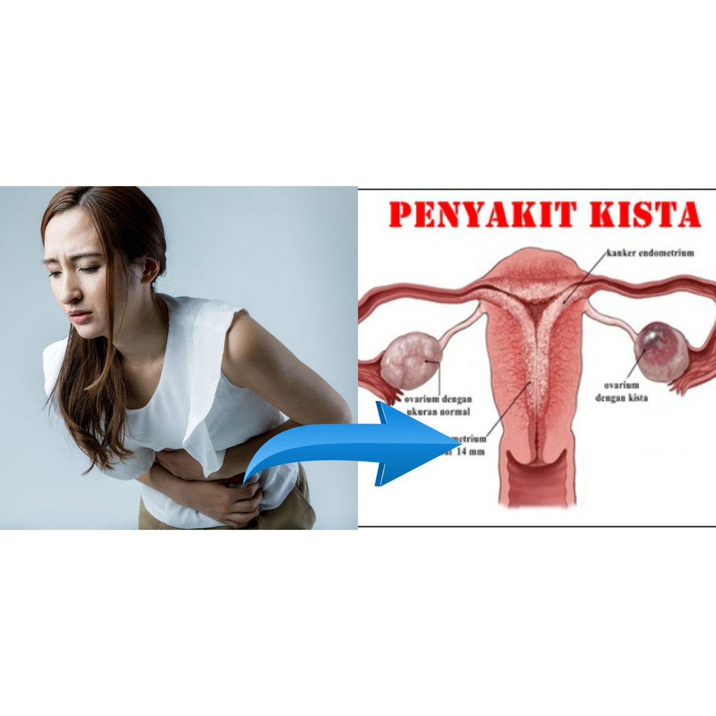 FrutaNext OBAT Mioma Syrup Herbal Obat Kista ORIGINAL Obat Herbal Kesehatan Wanita Menyembuhkan&Meng
