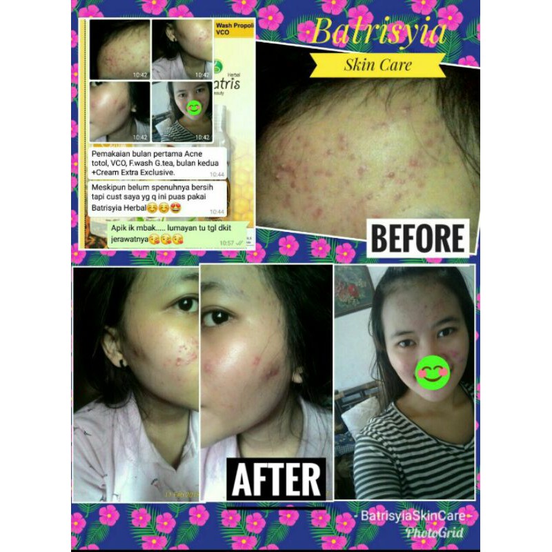 Batrisyia Herbal Acne cream totol jerawat besar meradang bruntusan