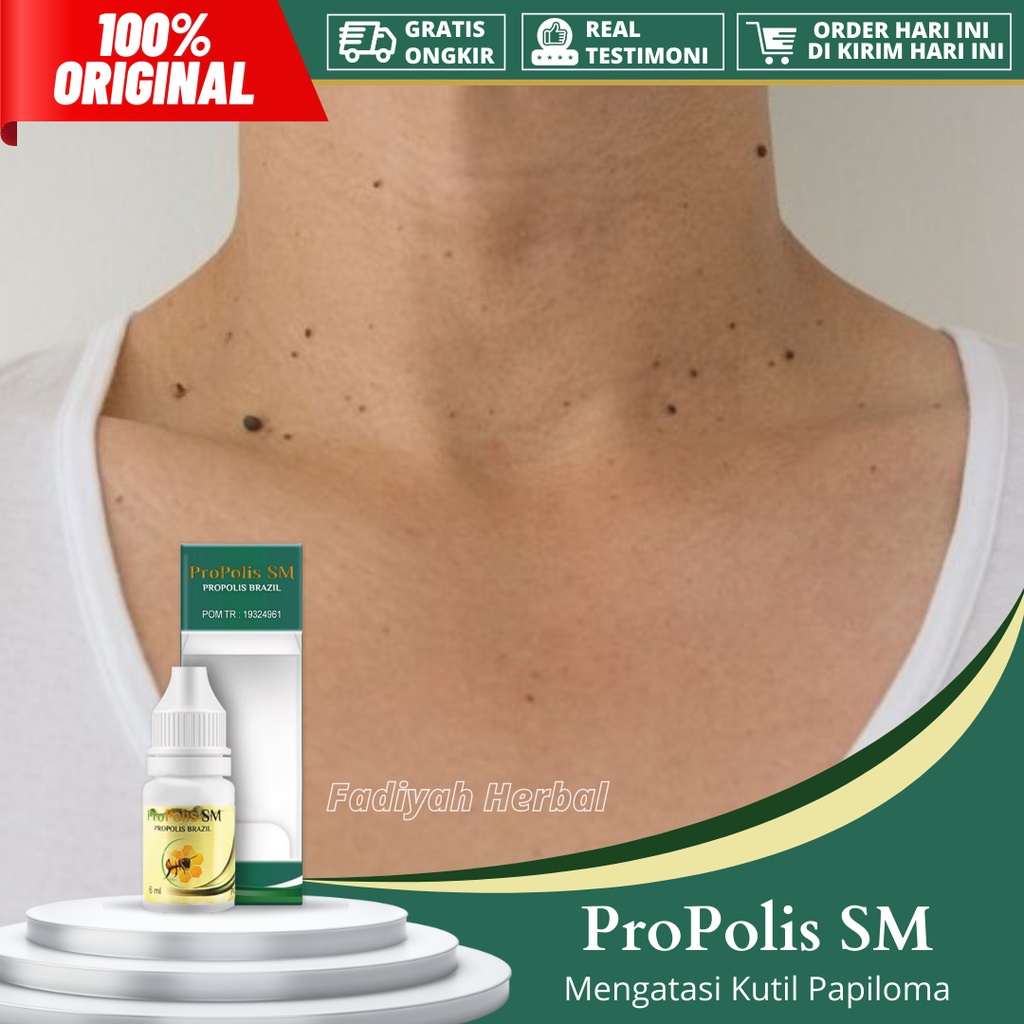 Obat Papiloma, Penghilang Papiloma, Penghilang Kutil di Leher, Obat Kutil di Leher, Perontok Kutil P