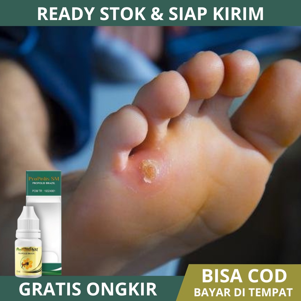 Obat Mata Ikan, Obat Mata Ikan Di Kaki Dan Tangan, Obat Mata Ikan Di Telapak Kaki / Tangan, Obat Per