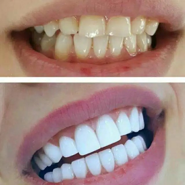 COMPOSITE VENEER SUPER WHITE DENTAL