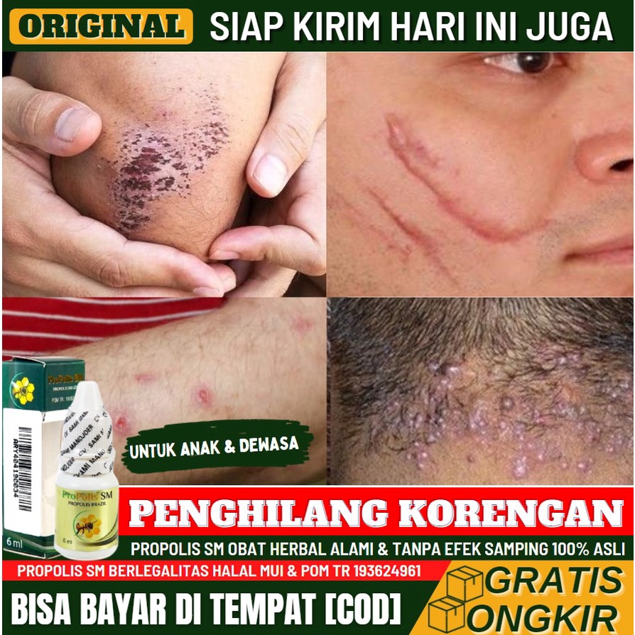 Obat Korengan Herbal Salep, Obat Menghilangkan Bekas Luka Hitam Menahun, Penghilang Korengan  Hitam 