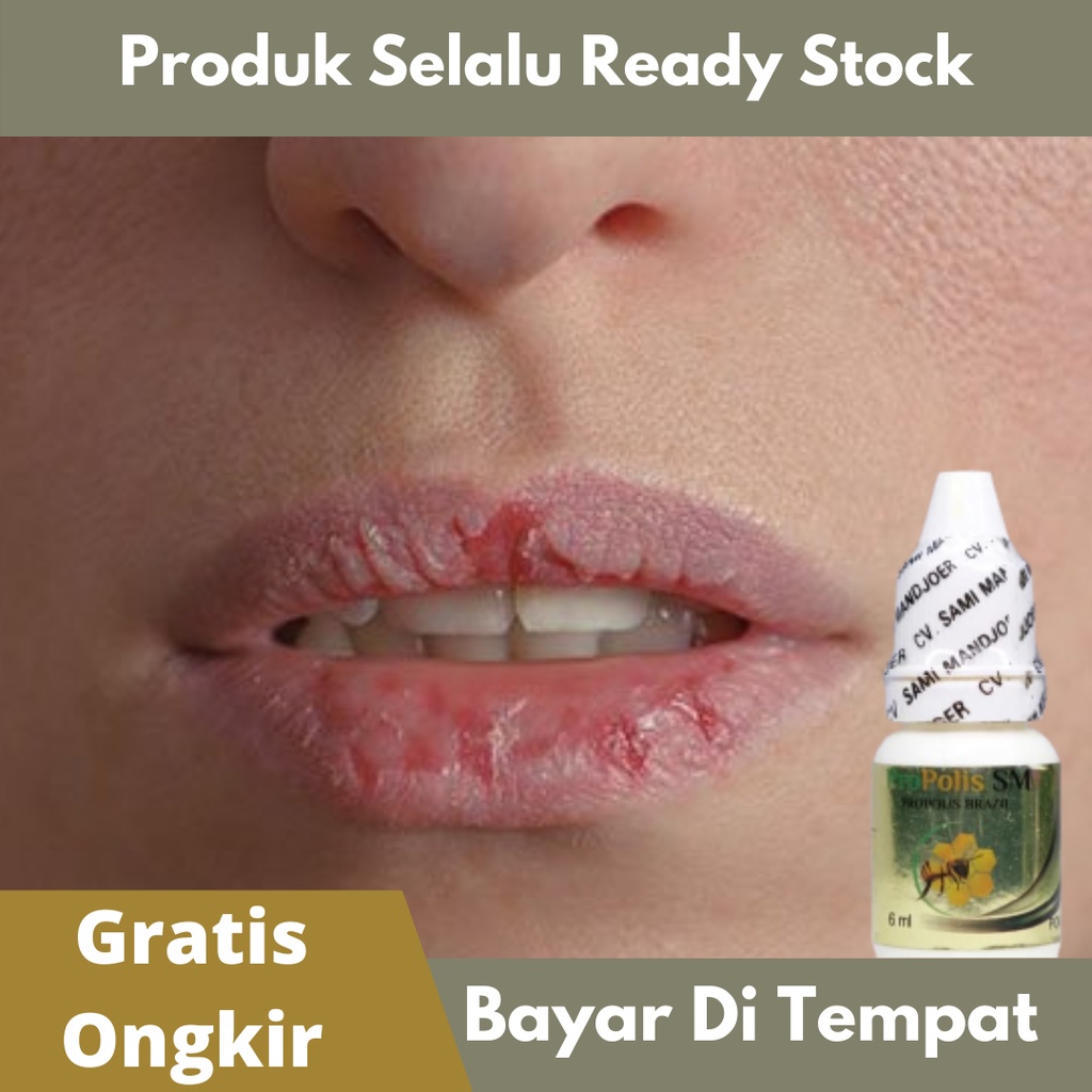 Obat Bibir Kering, Bibir Luka, Obat Sariawan, Bibir Pecah Pecah - PROPOLIS SM 100% ASLI