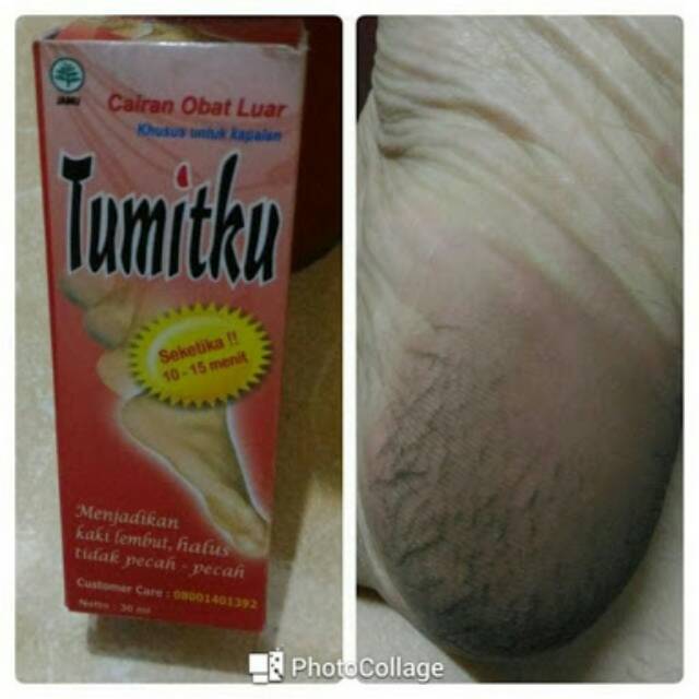 TUMITKU MINYAK OLES 30ML MENGATASI KAKI KERING KASAR PECAH-PECAH / KAPALAN SECARA INSTAN BPOM