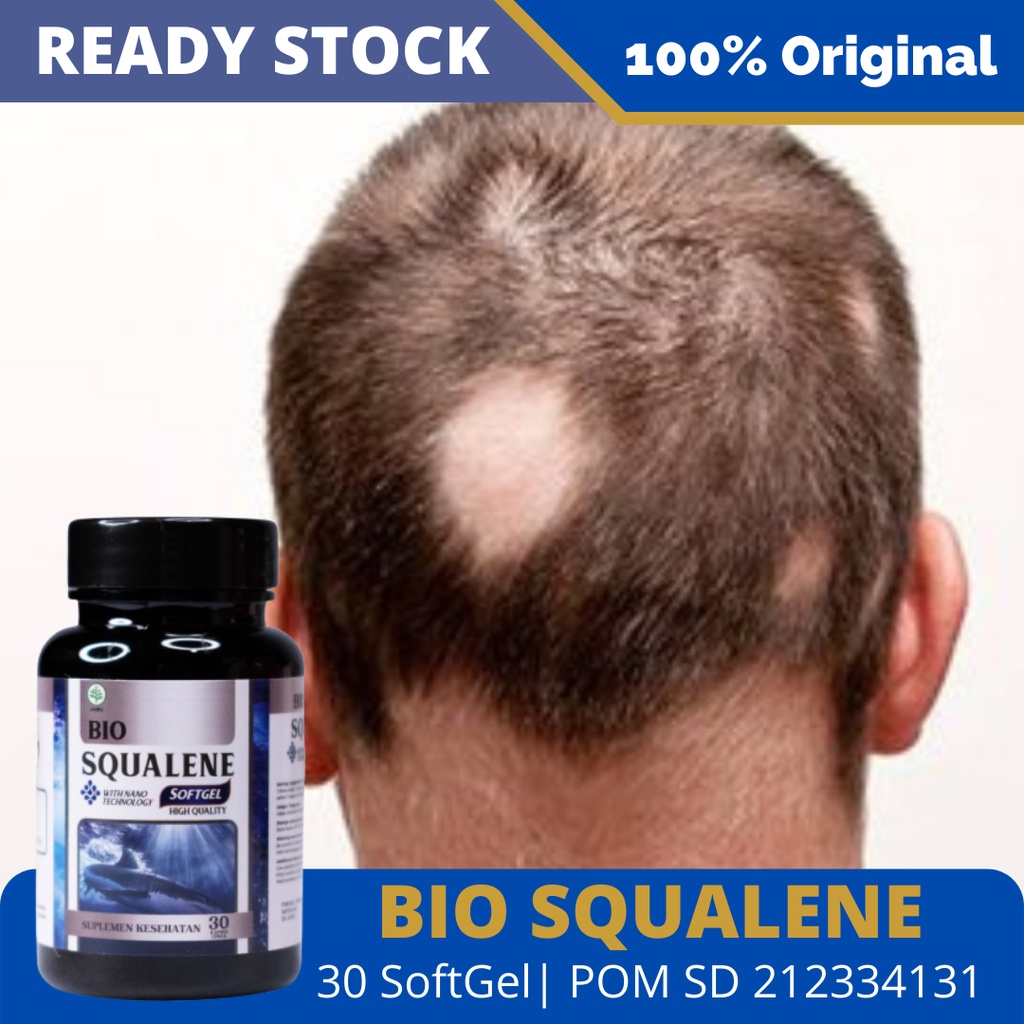 Obat Alopecia Areata, Penumbuh Rambut, Penumbuh Rambuh Botak, Penumbuh Rambut Secara Cepat Panjang, Penumbuh Rambut Bayi, Penumbut Rambut Di Jidat, Penumbuh Rambut Botak, Penumbuh Rambut Jidat, Penumbuh Rambut Rontok, Penumbuh Rambut Lebat