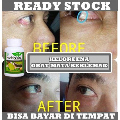 Obat Penghilang Timbul Berlemak Di Mata - Lamad Putih Di Mata, Mata Berlemak, Penyakit Pterigium, Lemak Mata, Selaput Putih Di Mata, Pembersih Lendir Pada Mata, Bintik Kuning Di Mata, Penjernih Mata Merah, Pterigium Dengan Keloreena 100% Original