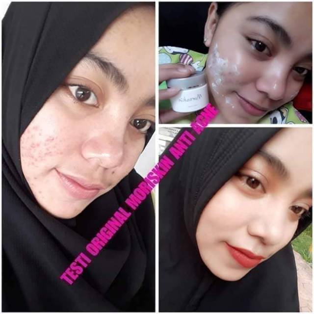 Moriskin Anti Acne Nasa