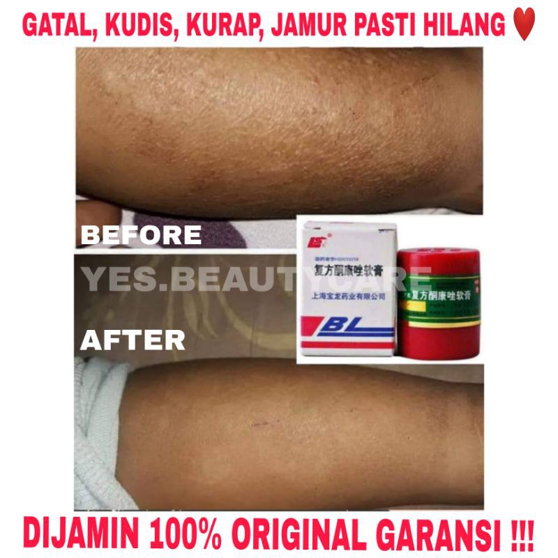 SALEP BL CREAM OBAT KULIT GATAL JAMUR EKSIM ALERGI KUDIS KURAP PANU KUTU AIR SALEB ORIGINAL IMPORT MURNI BPOM