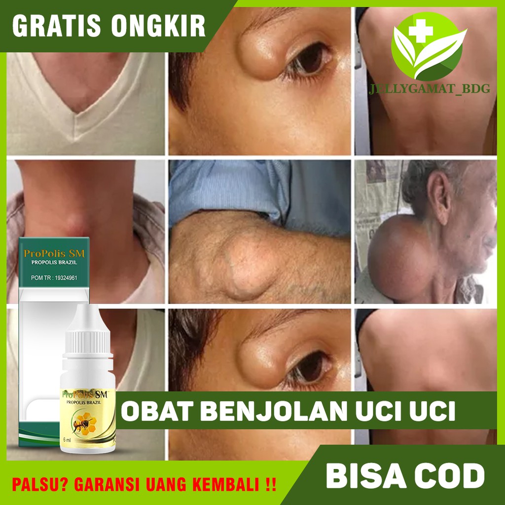 Jual Obat Benjolan Uci Uci Lipoma Benjolan Lemak Benjolan Di Leher Tiroid Propolis Sm Brazil 4713