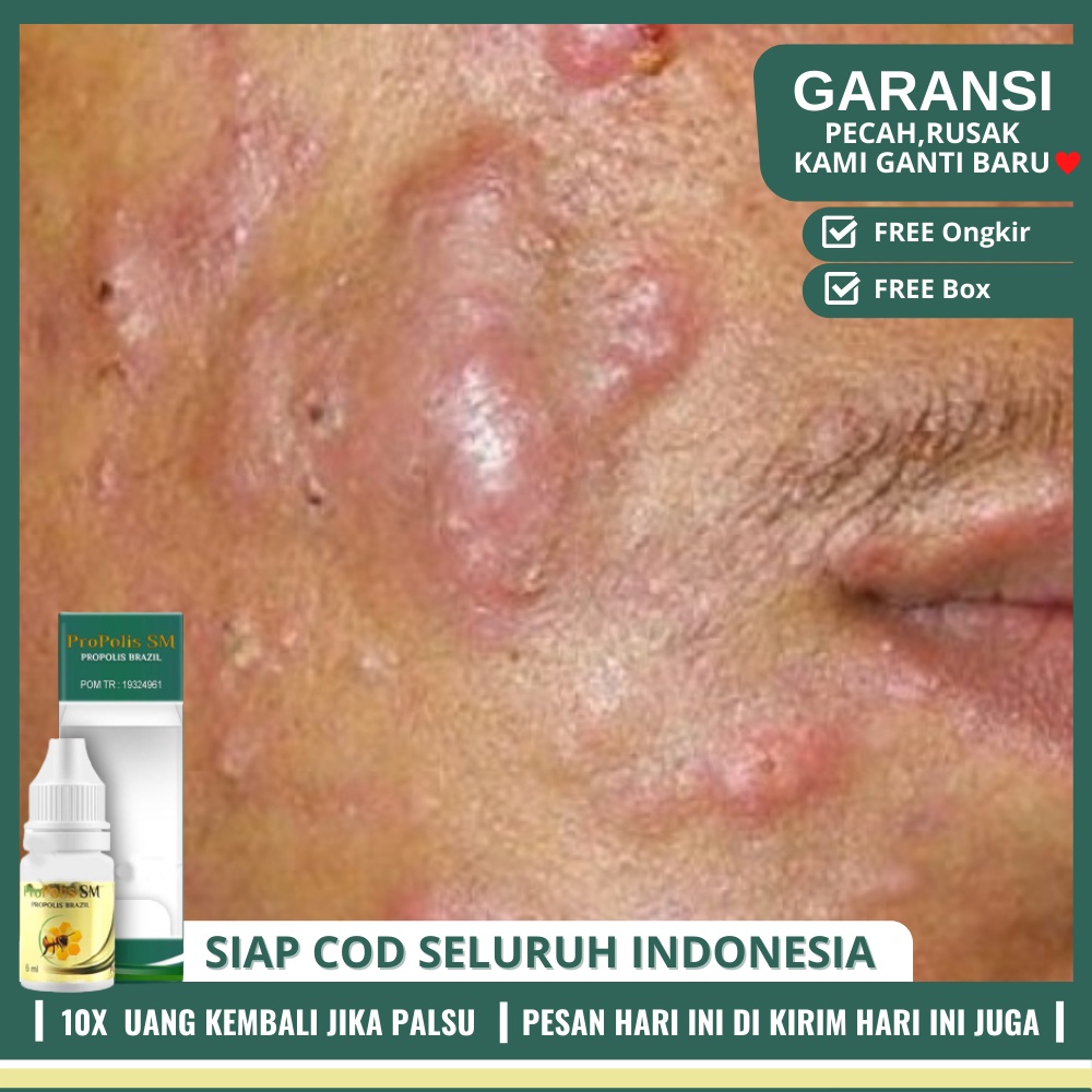 Propolis SM Obat Jerawat Di Wajah, Leher, Punggung, Badan, Dada - Penghilang Jerawat Dengan Alami