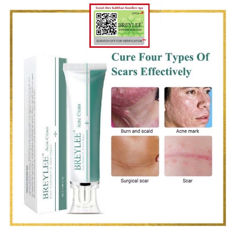 Krim Penghilang Bekas Luka - Acne Scar Removal Cream