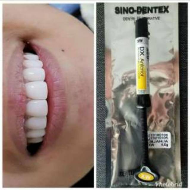 Composite Dentex Anterior XW dan Esthetica EXW Use Veneer Gigi 4gram