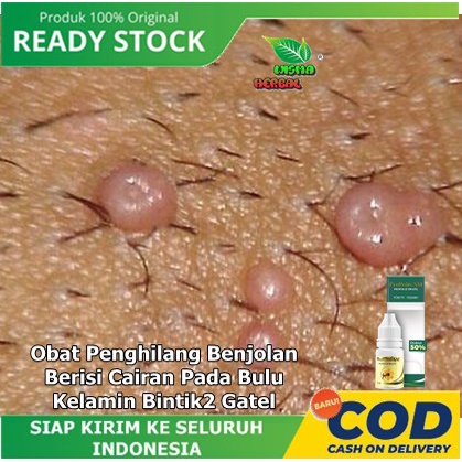 Obat Penghilang Benjolan Berisi Cairan Pada Bulu Kelamin Bintik2 Gatel, Propolis sm obat benjolan Ke