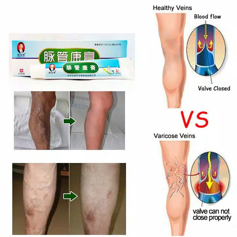 [ bisa COD] ~ SALEP PENGHILANG VARISES TRADITIONAL CHINA VARICOSE VEINS ORIGINAL